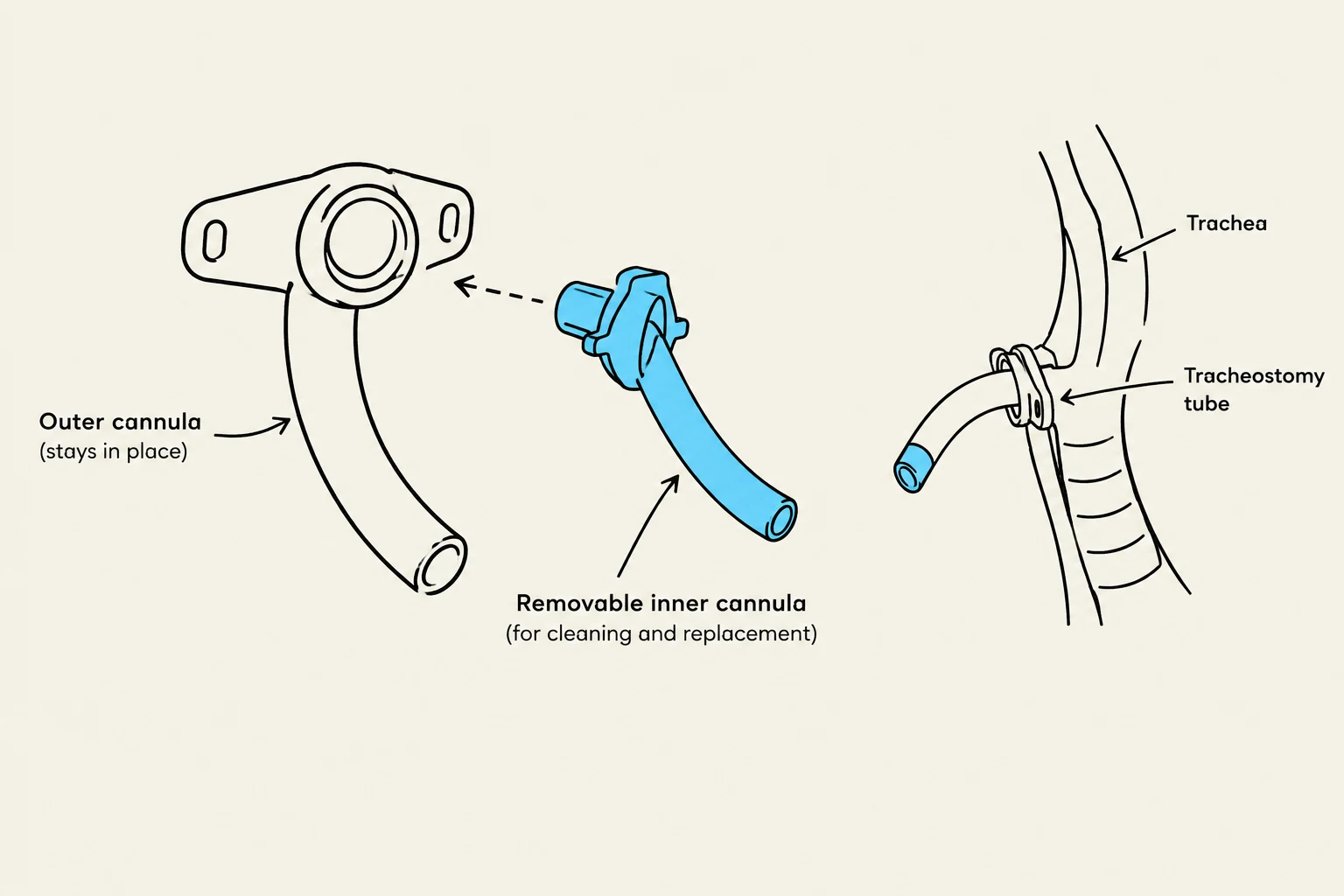 Diagram illustrating the components of a tracheostomy tube, including the outer cannula, removable inner cannula, and its placement within the trachea.