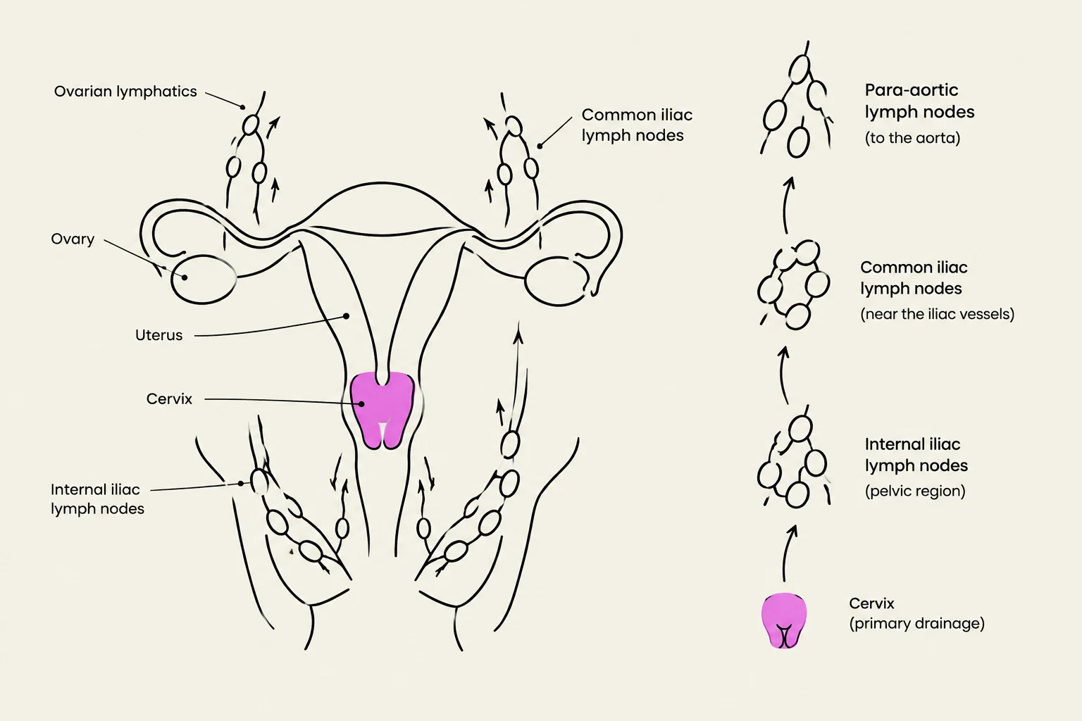 Diagram illustrating the lymphatic drainage pathways of the female reproductive organs, including the ovary, uterus, and cervix, to various lymph node groups such as internal iliac, common iliac, and para-aortic nodes.