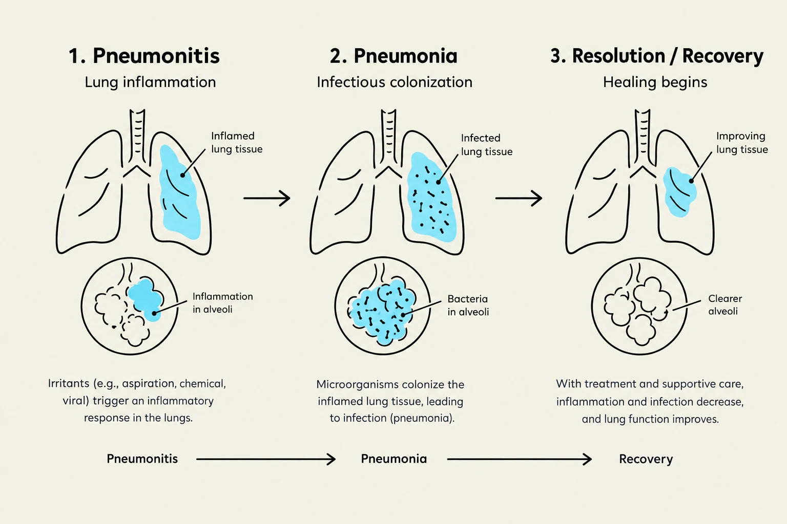 Diagram illustrating the progression of pneumonitis to pneumonia and subsequent recovery, showing changes in lung tissue and alveoli.