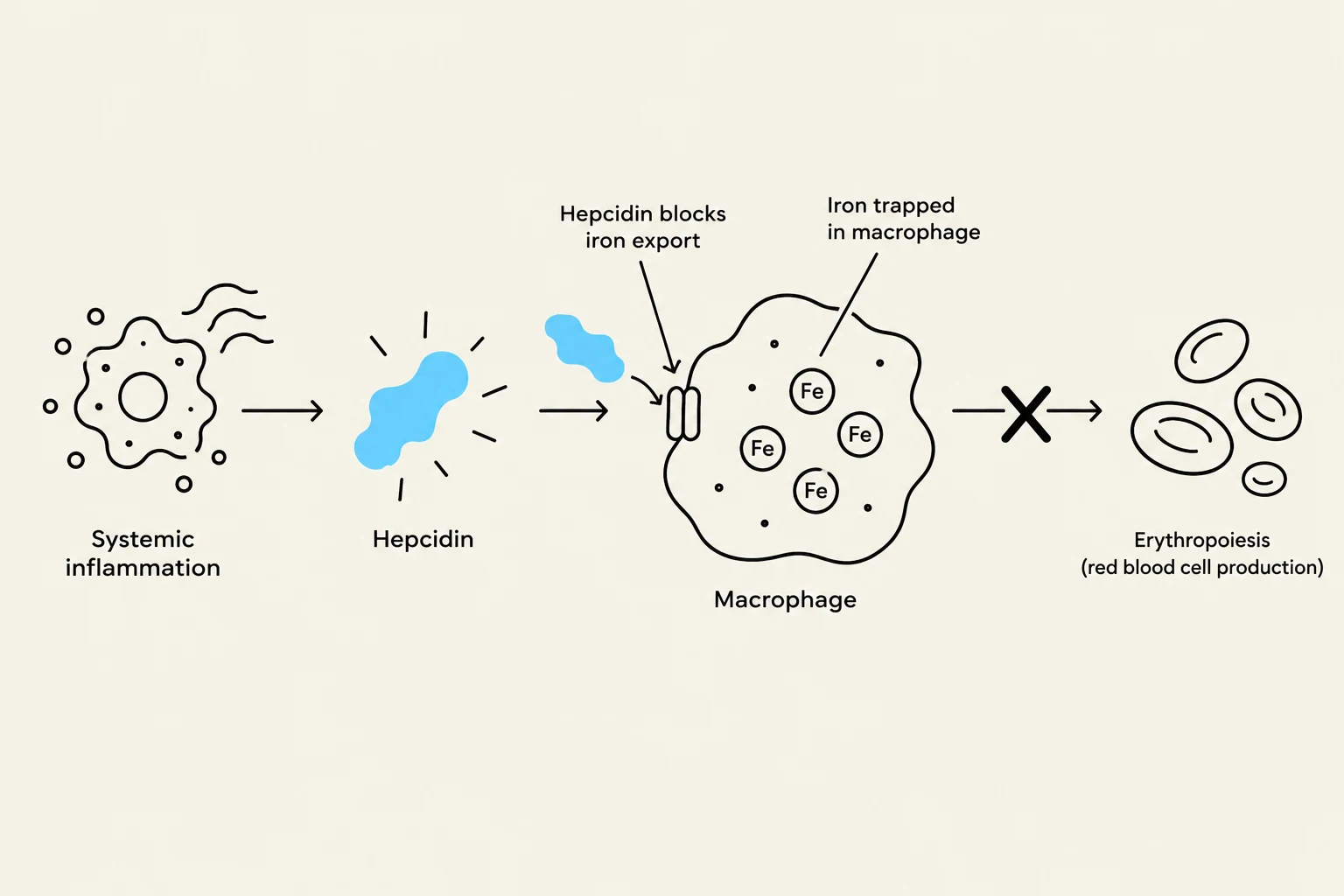 This diagram illustrates how systemic inflammation leads to the production of hepcidin, which blocks iron export from macrophages, thereby inhibiting erythropoiesis (red blood cell production).