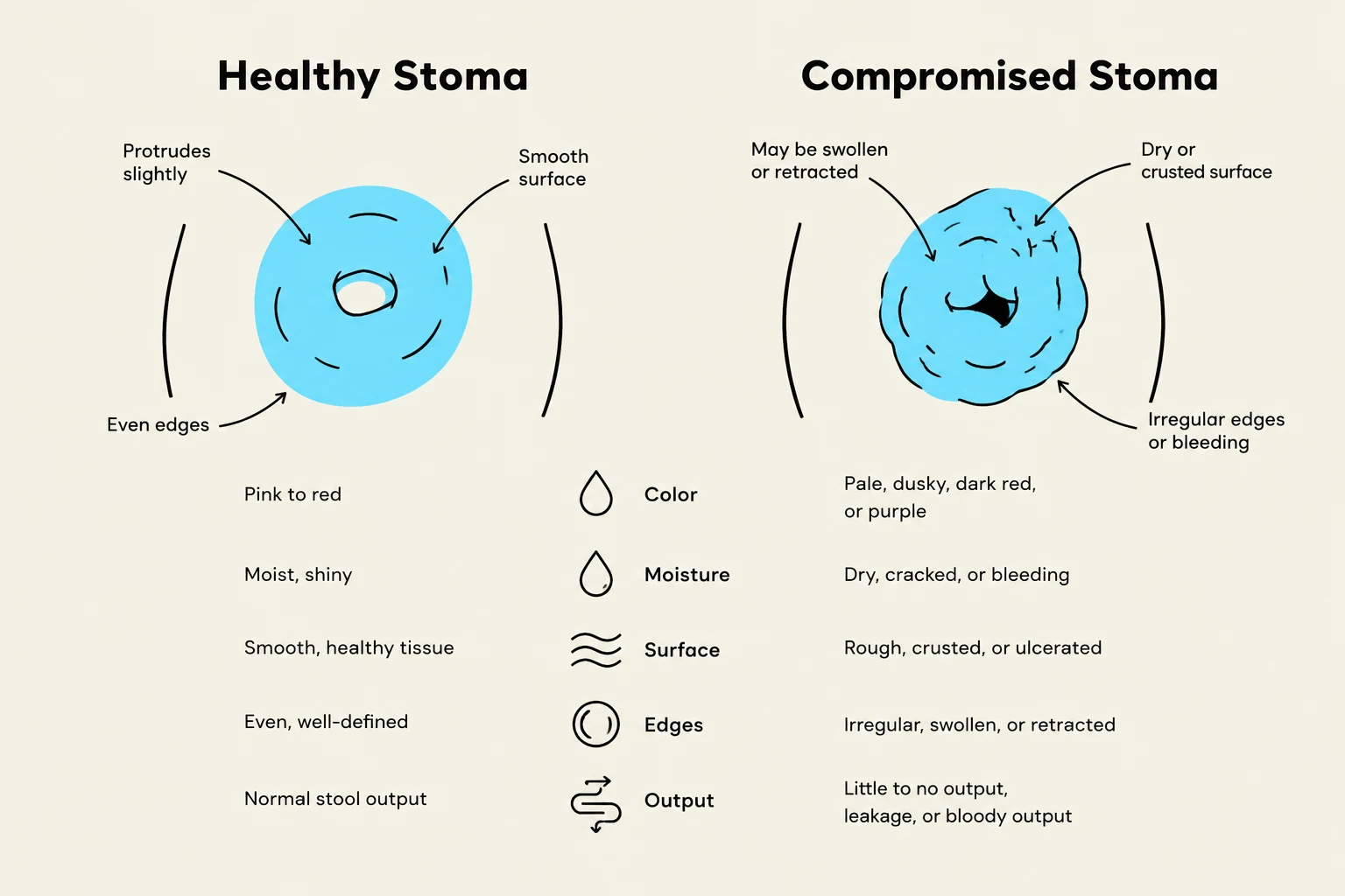 Comparison of a healthy stoma and a compromised stoma, detailing characteristics like color, moisture, surface, edges, and output.