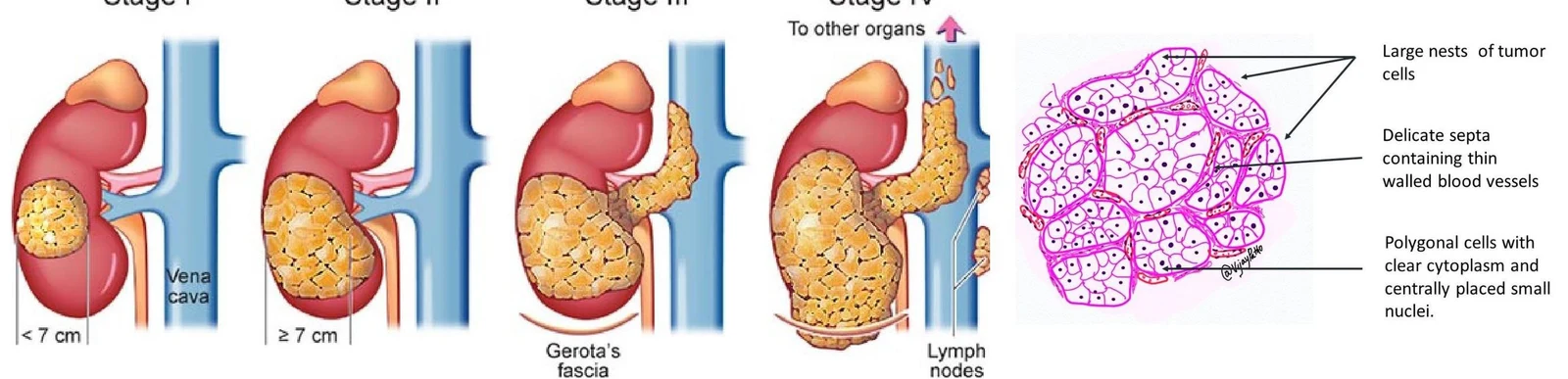 Diagram illustrating the staging of kidney cancer, showing tumor growth and spread through lymph nodes and to other organs, along with a microscopic view of tumor cells.