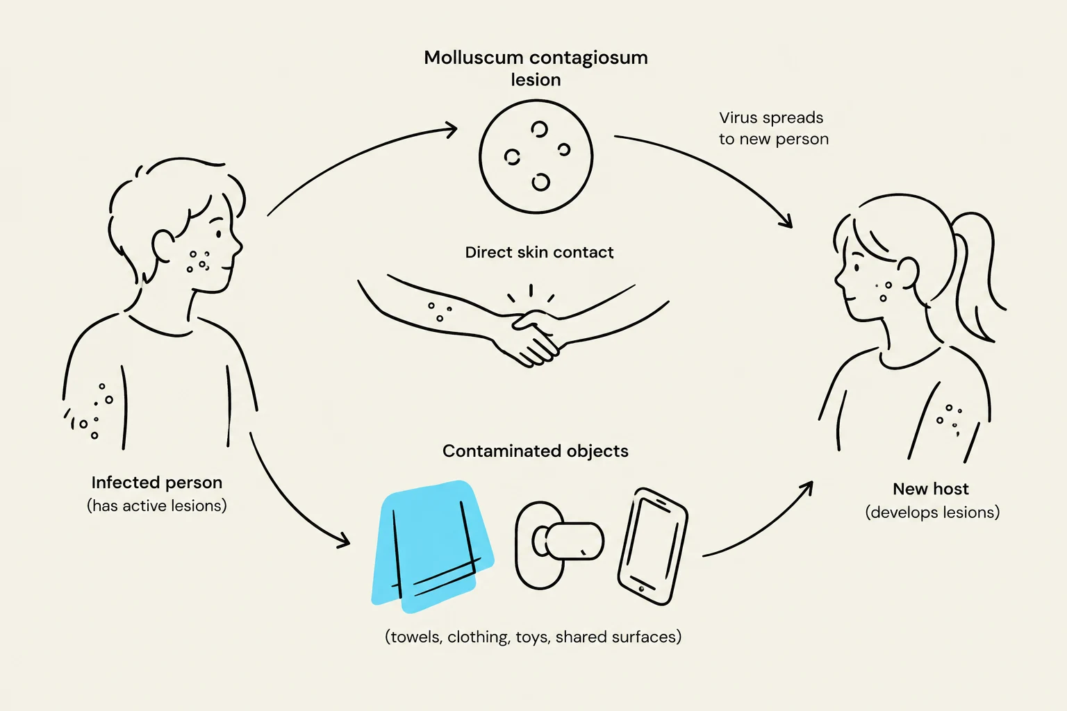 Diagram illustrating the transmission of molluscum contagiosum through direct skin contact and contaminated objects.