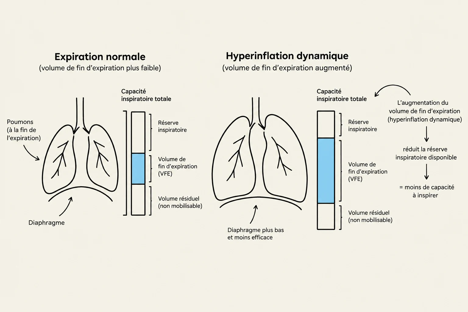 Diagram illustrating normal expiration versus dynamic hyperinflation, showing lung volumes and capacities.