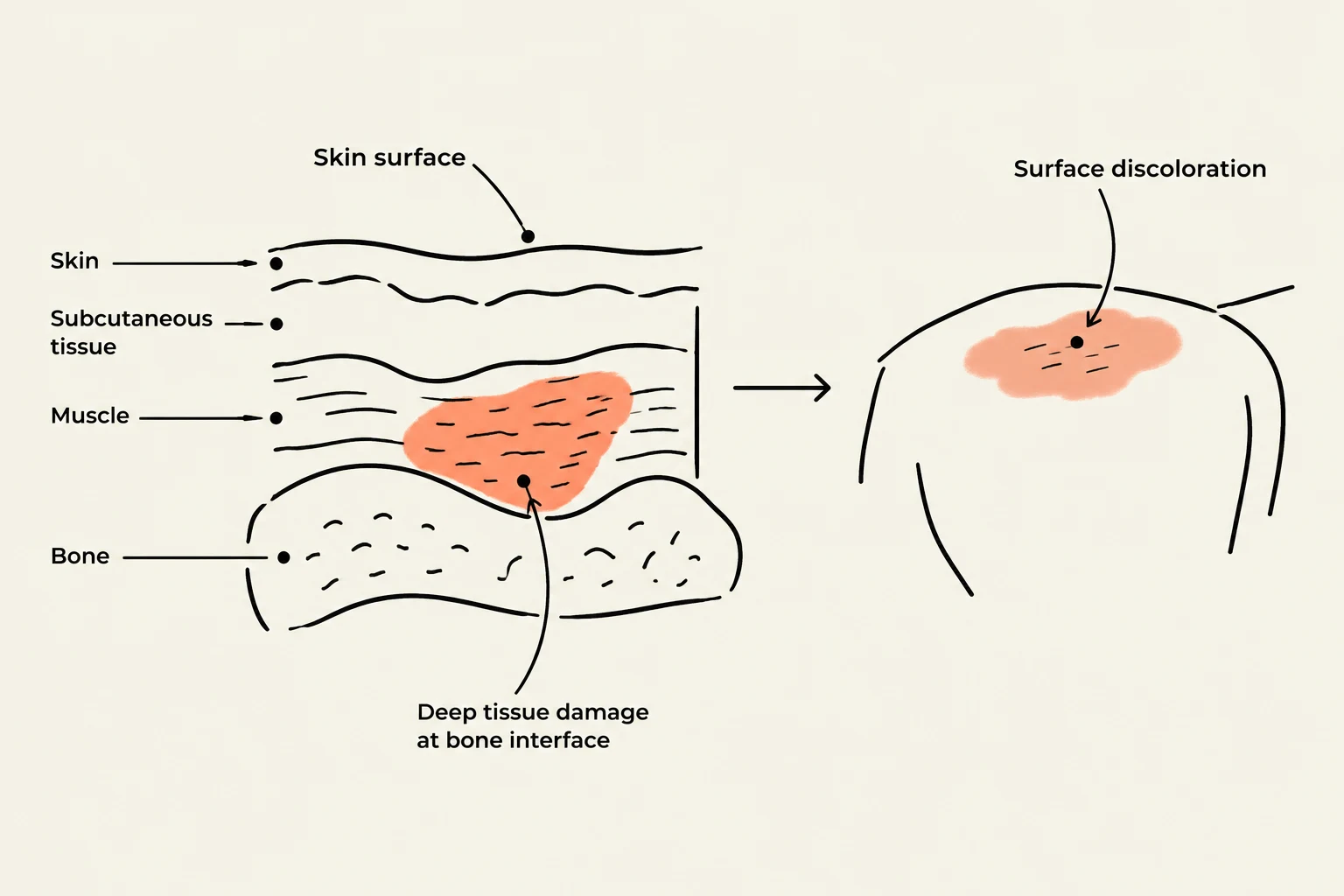 Diagram illustrating deep tissue damage and surface discoloration.