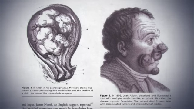 Historical medical illustrations of large, visible tumors.