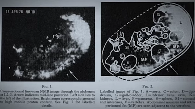 An early MRI image of the abdomen [<a href="https://youtube.com/watch?v=2oA6VIWWrdI&t=1978">1978</a>].