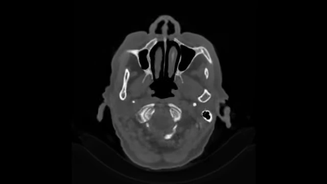 An MRI scan of a human skull