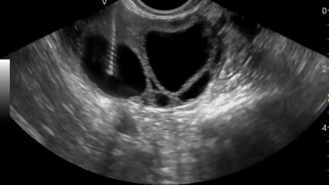 Ultrasound view during an egg retrieval procedure, showing a needle extracting fluid from follicles