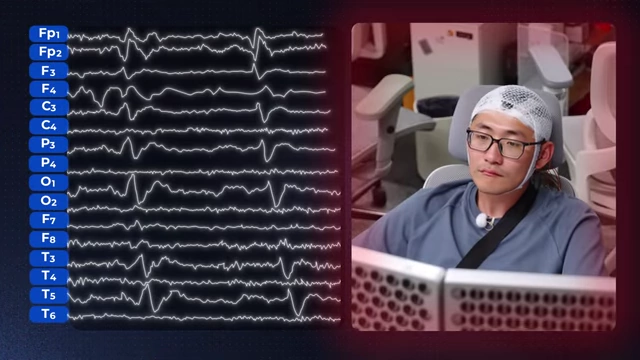 脑电图上眨眼导致的信号波动，与异常放电波形进行区分