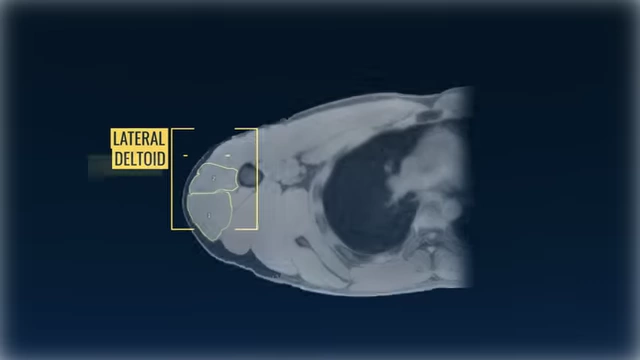 An MRI scan of a lateral deltoid muscle, with specific regions outlined for precise measurement and analysis.