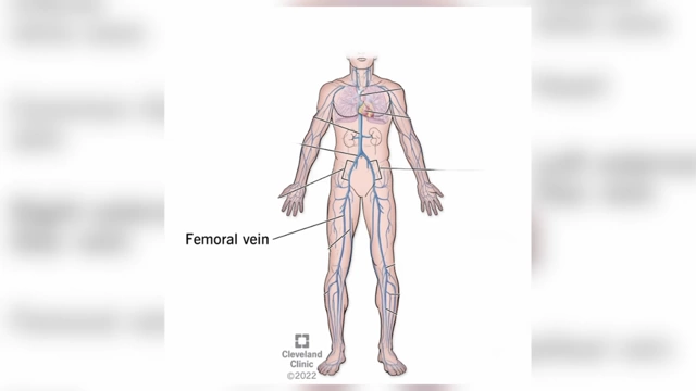 Diagram highlighting the femoral vein, where the IV was ultimately inserted