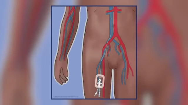 Diagram showing IV placement in the femoral vein near the groin