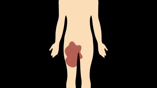 Diagram illustrating drugs pooling in the surrounding tissue due to IV line failure