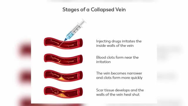 Diagram illustrating the stages of a collapsed vein, a cause of IV failure