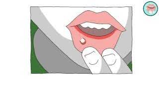 An image illustrating mouth sores, a sign of folate deficiency.