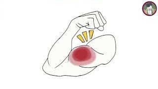 Illustration of a bicep with a red area, signifying muscle weakness.