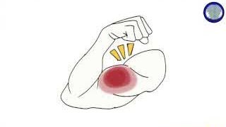 Image showing muscle weakness or pain.