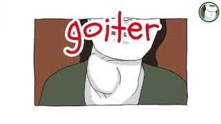 Image depicting a goiter, a visible lump on the neck caused by severe iodine deficiency.