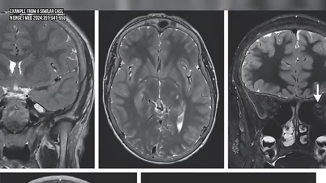 An example MRI scan from a similar case, highlighting a potential issue with the optic nerve, as seen in MN's MRI.