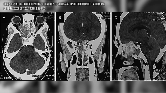 MRI scans showing a case of compressive optic neuropathy, demonstrating the type of mass that was ruled out for MN.