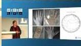 A slide showing various anatomical features on hands: top-left (normal view), top-right (superficial vein patterns mapped with blue dots), bottom-left (hand with freckles), bottom-right (infrared view of hand), and a cladogram illustrating variation.