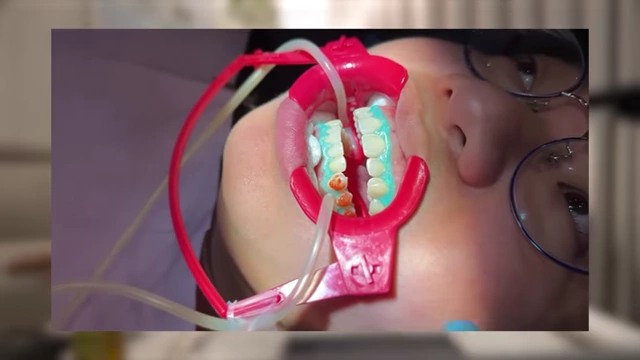 Patient undergoing in-office dental whitening with bleaching gel applied and gums protected
