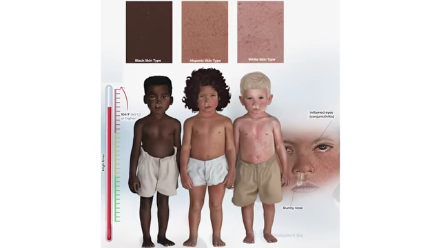 An illustration showing symptoms of measles on children with different skin types, including a high fever, inflamed eyes, and runny nose.