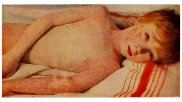 A historical image of a child suffering from measles, showing a widespread rash.