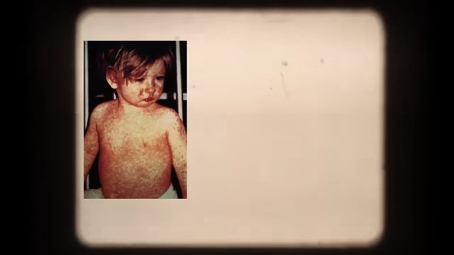 A historical image showing a child afflicted with a measles rash.