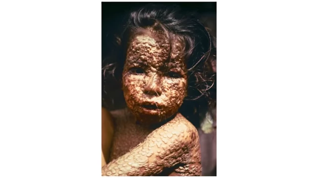 A close-up photograph of a child suffering from severe smallpox, illustrating the disfiguring effects of the disease.