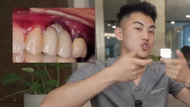 An example of an over-contoured dental crown creating a food trap by pushing down gum tissue