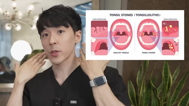 Visual comparison of healthy tonsils and tonsils affected by stones (tonsilloliths)