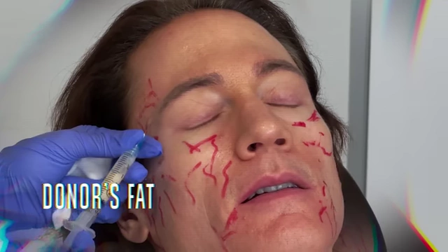 Syringes containing donor's fat being prepared for a facial fat transfer procedure on Bryan Johnson