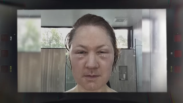 Bryan Johnson's face swollen after an allergic reaction to a cosmetic procedure