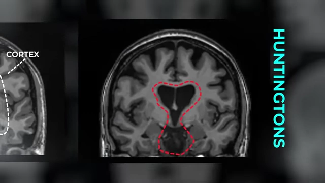 Comparison of healthy and Huntington's brains