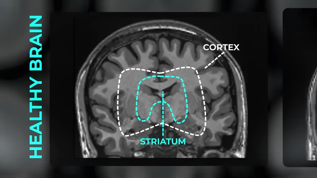 MRI scan of a healthy brain, showing the striatum and cortex