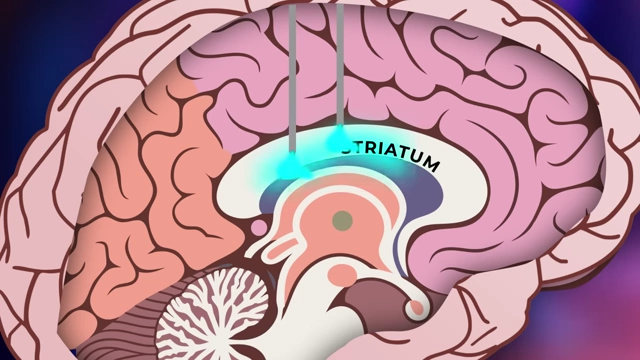 Neurosurgical delivery of viral solution into the striatum of the brain