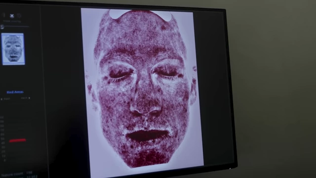 A screen displaying facial scan results, showing UV damage on skin.
