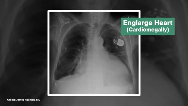 An X-ray showing an enlarged heart (cardiomegaly), a condition that semaglutide may help reduce through preventing heart remodeling.