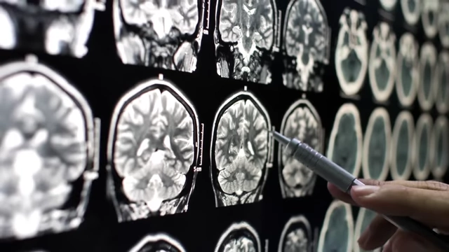 A doctor pointing to MRI scans of the brain, highlighting potential neurological benefits.