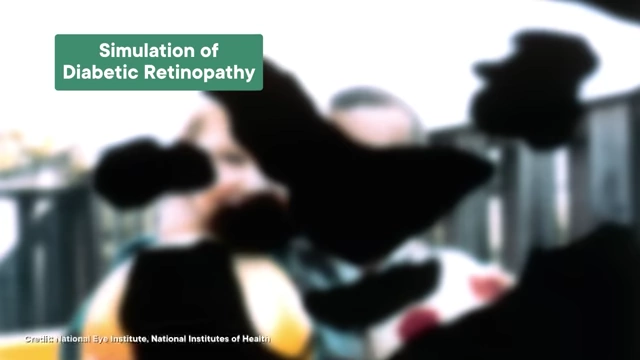 A simulation showing the visual impairment caused by diabetic retinopathy, a condition whose risk may be increased by semaglutide with rapid blood sugar drops.