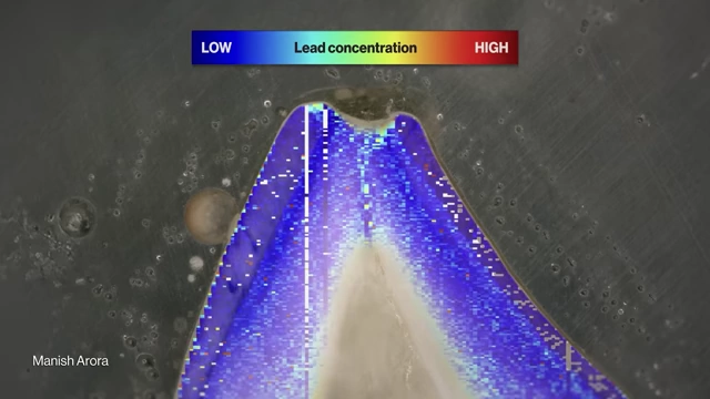 A heatmap of lead concentration in Adam's baby tooth cross-section, showing very low levels (blue/green), indicating low exposure.