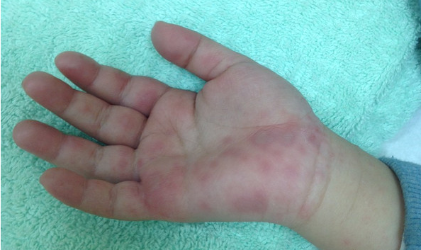 今年首例腸病毒重症 南部4歲女童已康復出院！