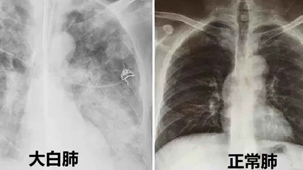 肺纖維化有望「逆轉」英科智能臨床數據成效佳