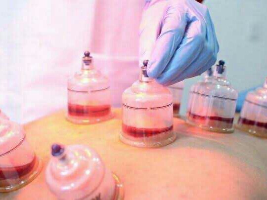 Terapi Bekam/Hijamah