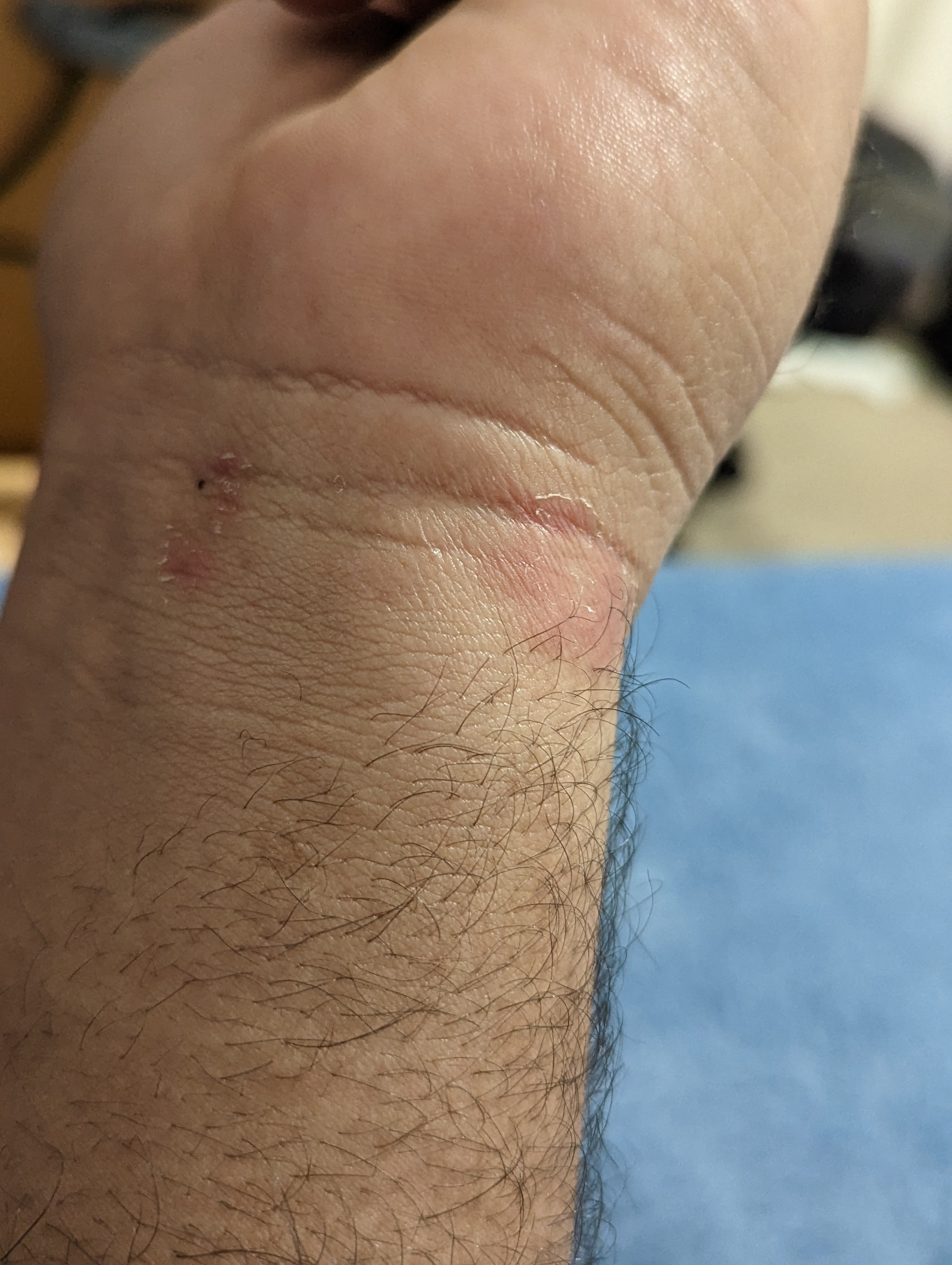 Strap causing intense rash/friction burn? - Google Pixel Watch Community