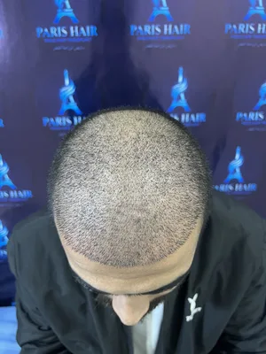 عيادة باريس لزراعة الشعر