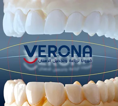 عيادات فيرونا لزراعة وتجميل الأسنان