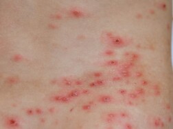 Kako se prenosi i liječi herpes zoster Koža zaražena herpesom zosterom u obliku vodenih kozica